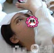 温岭芘丽芙整形医院2020年价格表更新_双眼皮整形果实拍