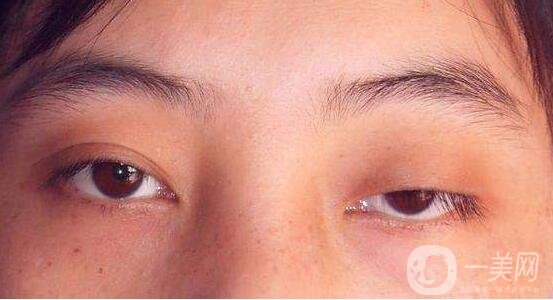 眼睑下垂矫正手术有风险吗需要住院吗