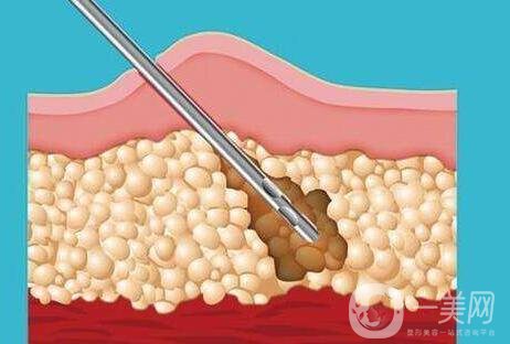 关于吸脂手术的流程与*性，你都知道吗？