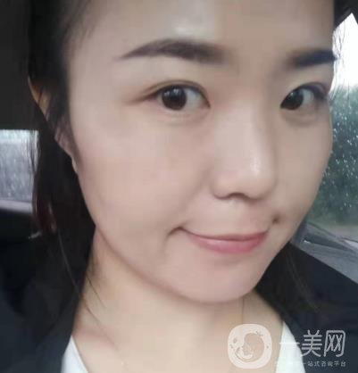 吉大一院整形美容科价格表费用明细，附祛斑案例