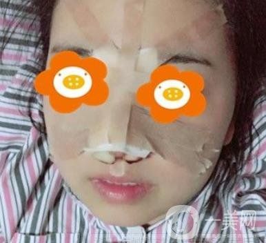 重庆西南医院整形外科价格表2020_自体脂肪填充鼻部案例