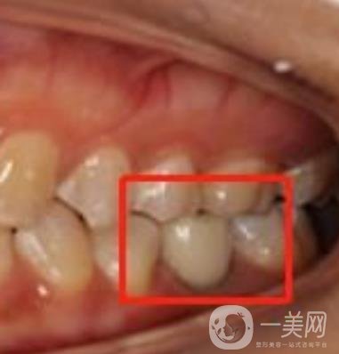 中大光华口腔医院种植牙多少钱?价格表2020年项目明细一览