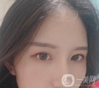 北京处布仁医生隆鼻案例，看整形价格及果怎么样