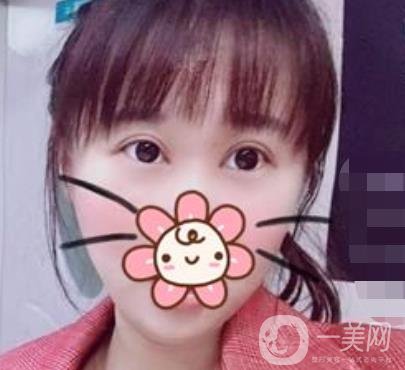 上海华美杨亚益做眼睛多少钱？价格表及案例详情