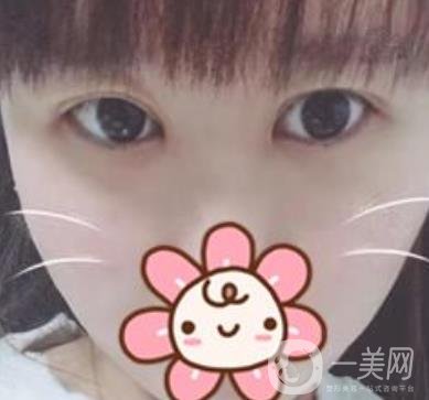 上海华美杨亚益做眼睛多少钱？价格表及案例详情