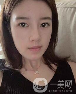 盐城东方女子整形医院价格表明细，附隆鼻案例