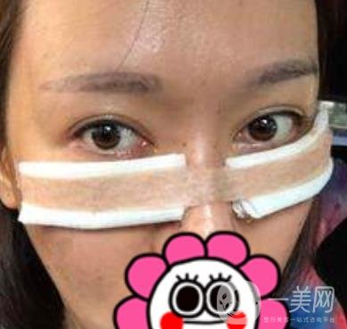 北京友谊医院整形科祛眼袋*果好不好？2020年价格价目收费曝光啦