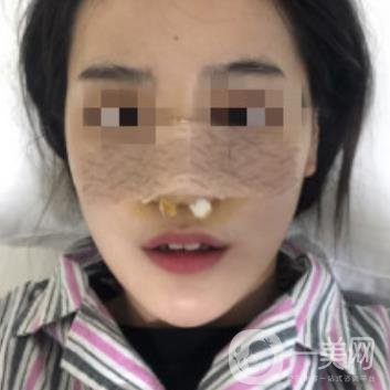 深圳人民医院整形外科价目表，附隆鼻案例