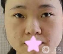 宝鸡人民医院美容科价格表及*前后恢复图