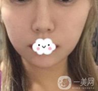 华西口腔医院*多少钱？附术后果前后