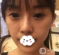 金华中心医院整形科价格表及自体脂肪填充面部案例展示