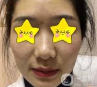 深圳北大医院整形科价格表及自体脂肪填充面部果一览