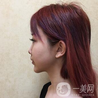 广州曙光医学美容医院价格表及肋软骨隆鼻案例分享