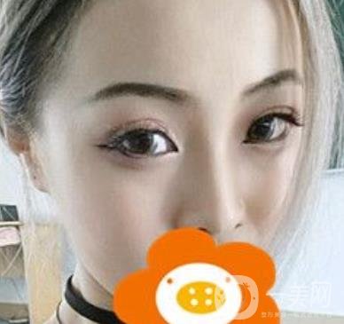 蚌埠美莱坞整形医院玻尿酸隆鼻*果如何？价格表2020年收费公布