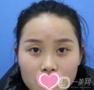 沈阳名流整形医院价格表，附双眼皮+隆鼻案例