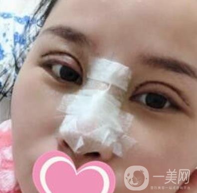 沈阳名流整形医院价格表，附双眼皮+隆鼻案例