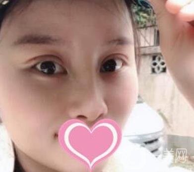 沈阳名流整形医院价格表，附双眼皮+隆鼻案例