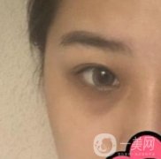 沈阳杏林整形医院割双眼皮果咋样?看实例及价格表