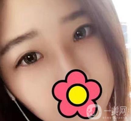 沈阳杏林整形医院割双眼皮*果咋样?看实例及价格表