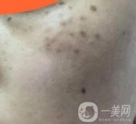 沈阳伊美尔整形医院价格表，附祛斑果展示