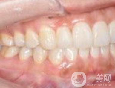 武汉大学口腔医院牙齿矫正多少钱?*果好吗?价格费用明细一览