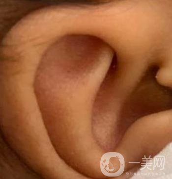 中国医学科学院整形外科医院外耳再造技术如何?*果好吗?价格表收费标准一览