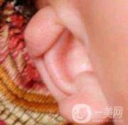 中国医学科学院整形外科医院外耳再造技术如何?果好吗?价格表收费标准一览