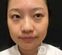 北京知音医疗美容热玛吉果怎么样？贵吗？收费价格表2020公布