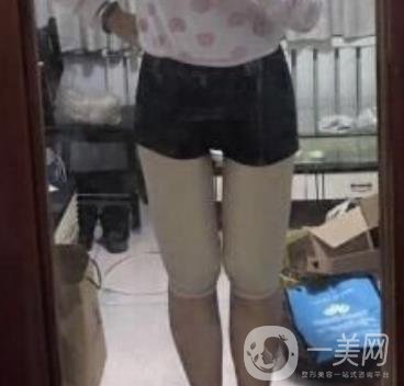 武汉市武昌医院整形美容科价格表和吸脂瘦大腿案例精选图公布