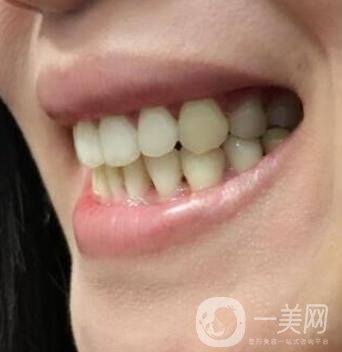 北京市海淀医院口腔科价格表2020更新，附牙齿矫正案例