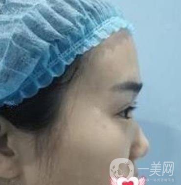 上海市第一人民医院整形科隆鼻大概要多少钱?附价格明细一览表