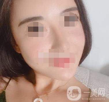 哈尔滨医大二院整形美容科价格表上线，附*案例