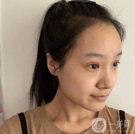 沈阳名流整形医院双眼皮案例