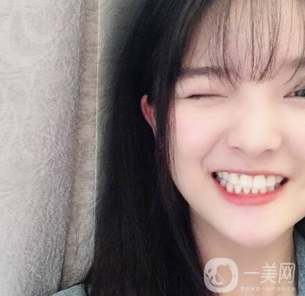 北大口腔医院梁成正颌案例