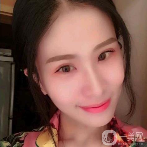 哈尔滨雅美整形医院双眼皮案例