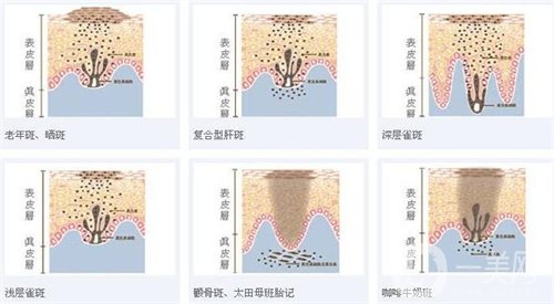 天津医科大学肿瘤医院整形科价格表，附激光祛斑恢复*果图