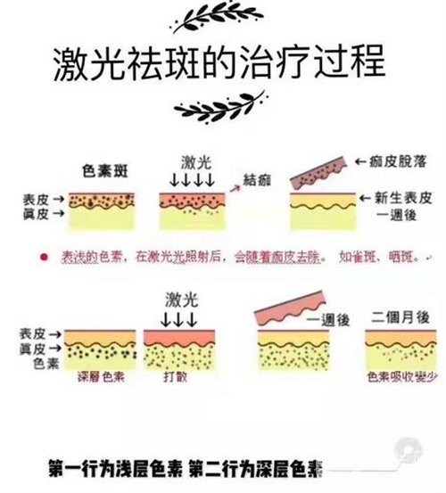 天津医科大学肿瘤医院整形科价格表，附激光祛斑恢复*果图