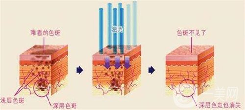 天津医科大学肿瘤医院整形科价格表，附激光祛斑恢复*果图