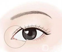 影响双眼皮恢复时间的因素是什么？