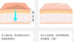 像素激光和点阵激光的不同之处是什么？