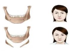 下颌角整形是削骨吗，下颌角整形意味着什么？