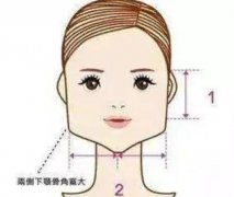 下颌角截骨术完全恢复需要多长时间？