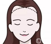 脱发际线产生的副作用如何避免？