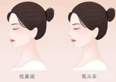 假体隆鼻对人体有害吗?隆鼻后假体变化大吗?