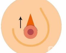 乳晕手术的特点是什么?需要注意哪些事项？