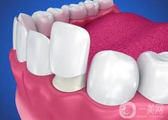 做了烤瓷牙可以做核磁共振吗？