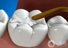 补牙是不是*性的？