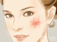 红血丝去除手术要多少钱？