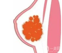 奥美定是什么？取出后的残留物取会致癌吗