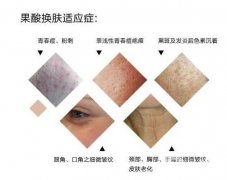 果酸换肤调节的间隔时间是多久？